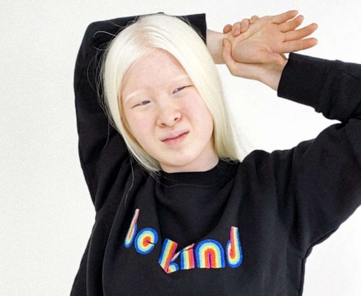 How a girl with albinism from a Chinese orphanage became a model for Vogue