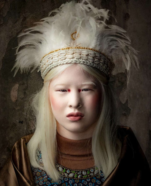 How a girl with albinism from a Chinese orphanage became a model for Vogue