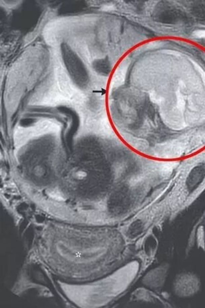 Ребенок рос в кишечнике: женщина случайно узнала о внематочной беременности на 23 недели